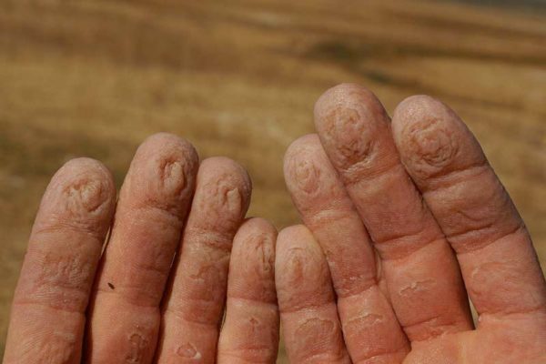 Das Bild zeigt die aufgedunsenen Finger eines Kletterers nach einem heißem Bad. Man sieht dass hier eine Klettercreme wichtig wäre.